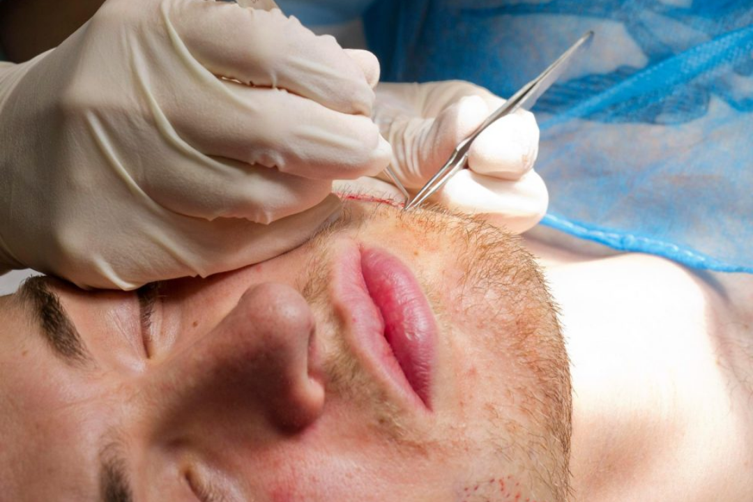 Beard Transplant procedure