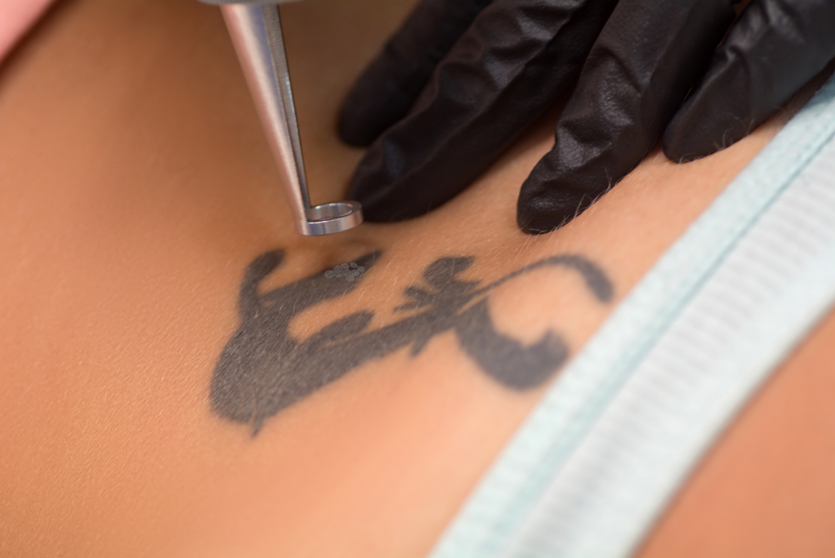 Laser tattoo removal process