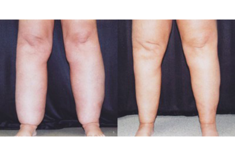 What Are Cankles? Hispotion